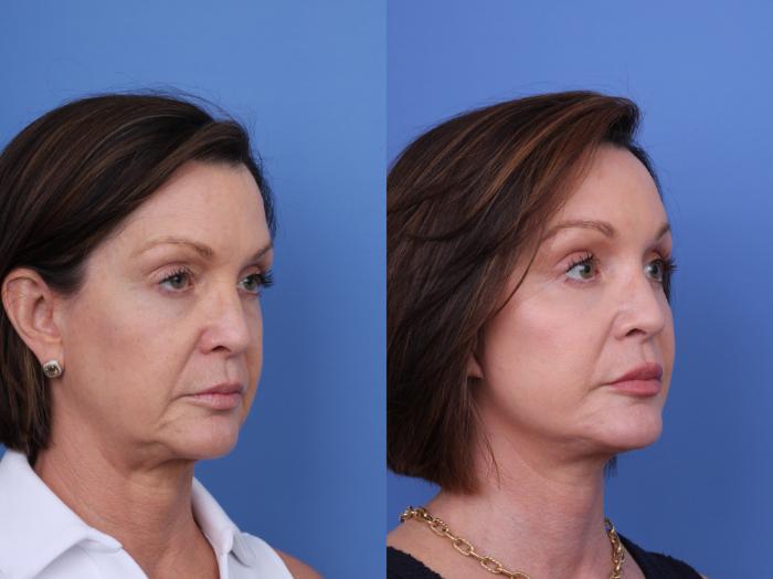 Before & After Blepharoplasty Case 712 Right Oblique View in Scottsdale, AZ