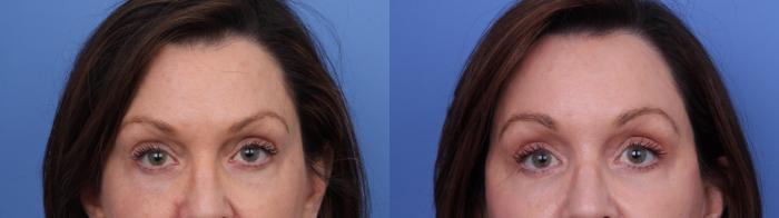 Before & After Blepharoplasty Case 712 Zoom Blepharoplasty View in Scottsdale, AZ