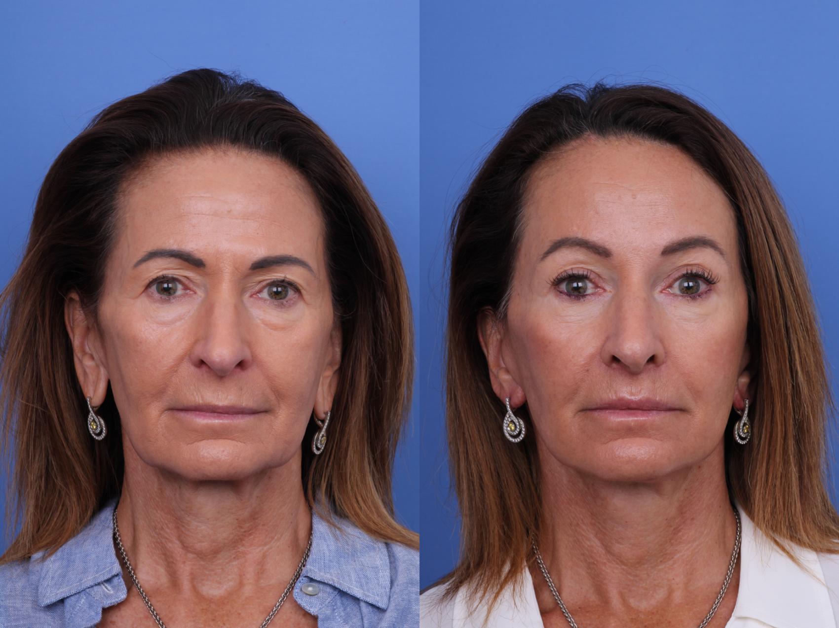 Before & After Facelift Case 714 Front View in Scottsdale, AZ