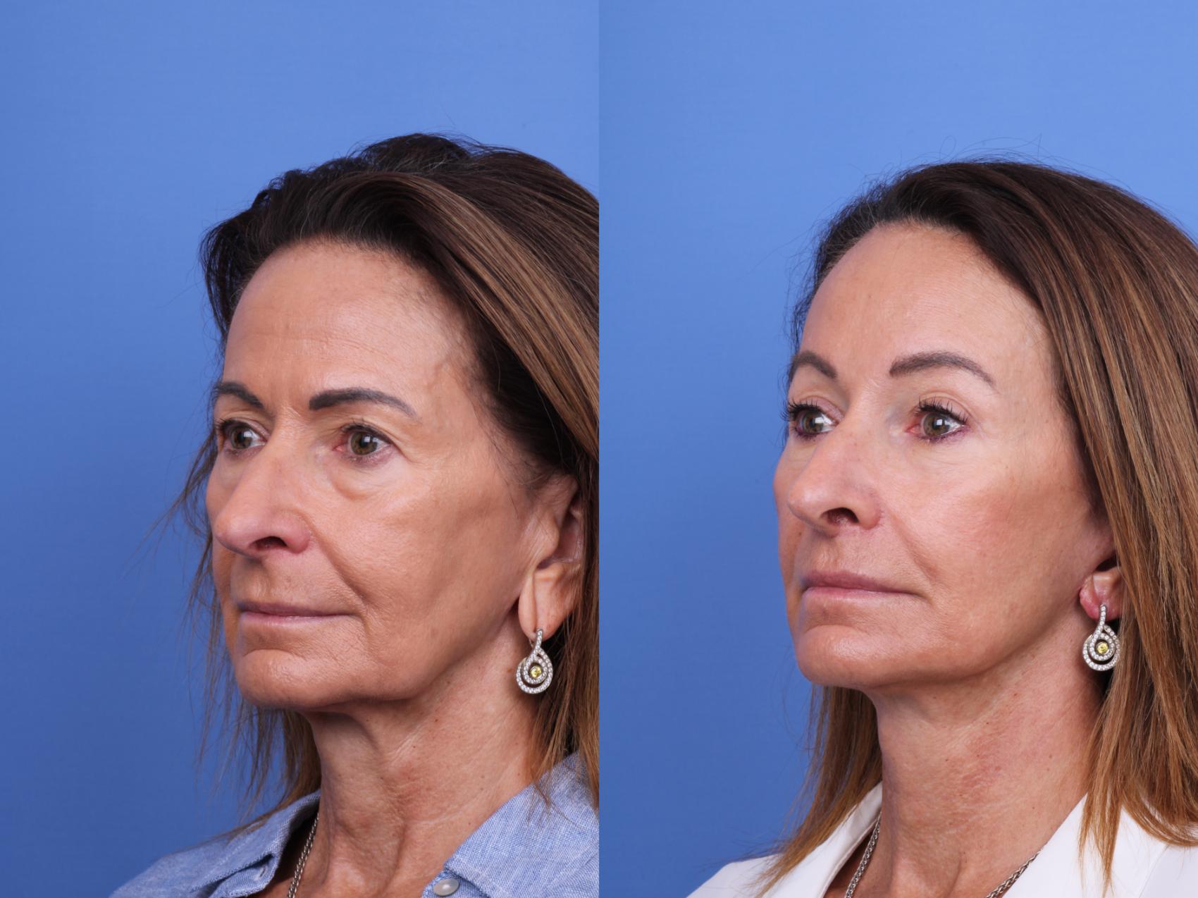 Before & After Facelift Case 714 Left Oblique View in Scottsdale, AZ