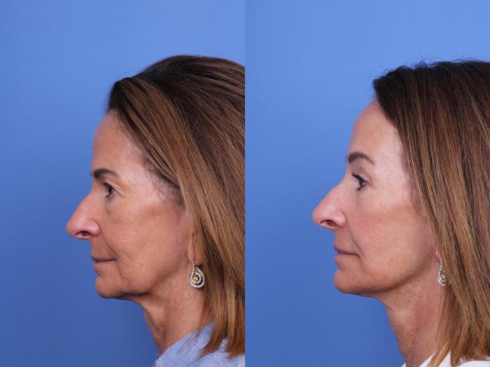 Before & After Facelift Case 714 Left Side View in Scottsdale, AZ