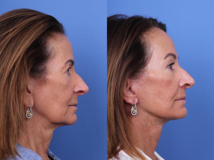 Before & After Facelift Case 714 Right Side View in Scottsdale, AZ