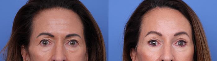 Before & After Facelift Case 714 Zoom Blepharoplasty View in Scottsdale, AZ