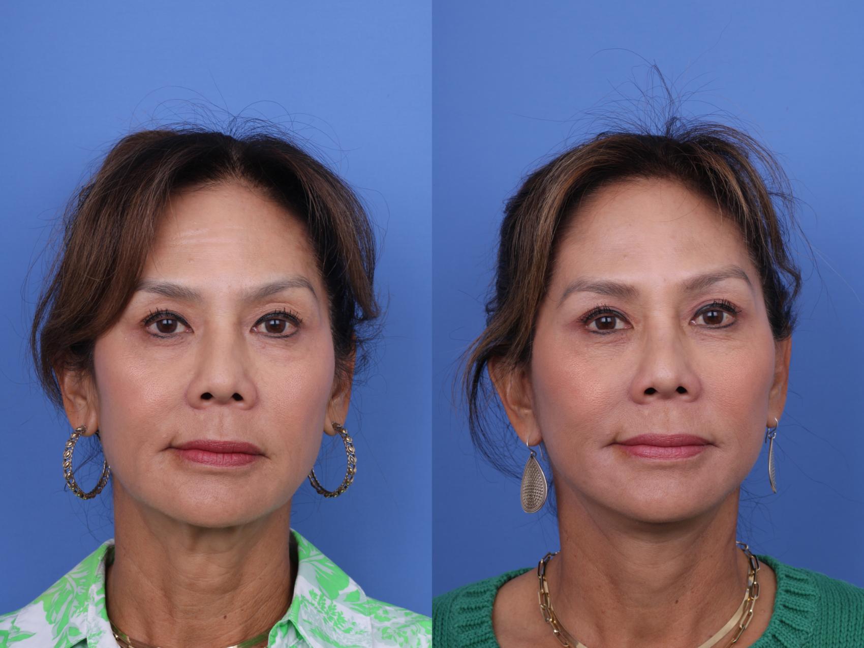 Before & After Facelift Case 716 Front View in Scottsdale, AZ