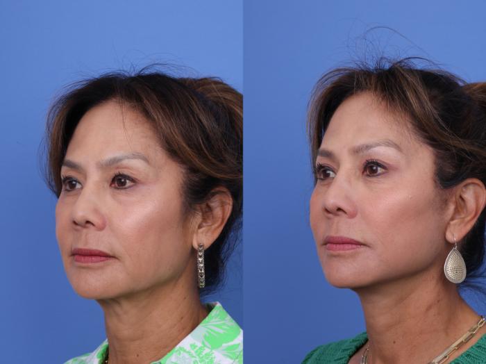Before & After Facelift Case 716 Left Oblique View in Scottsdale, AZ