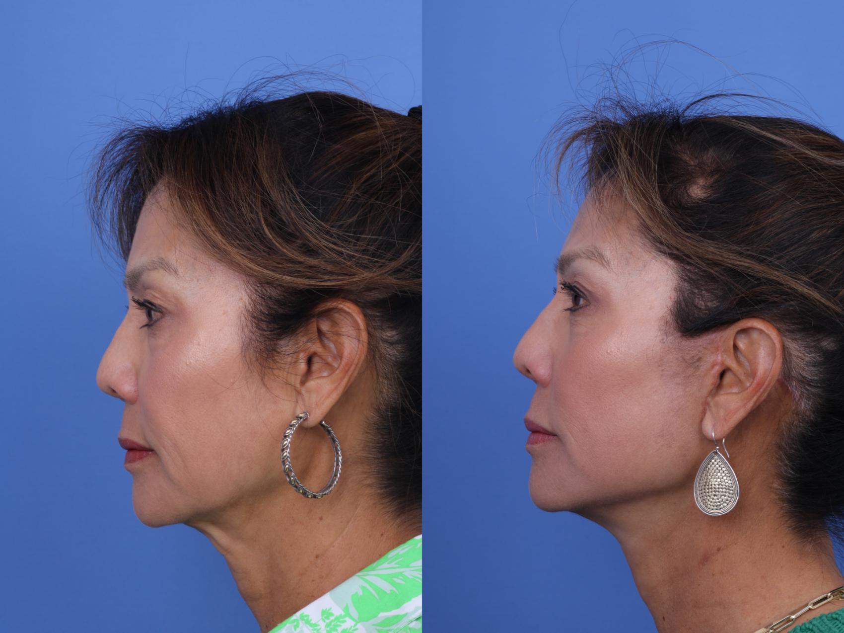 Before & After Facelift Case 716 Left Side View in Scottsdale, AZ