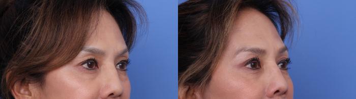 Before & After Facelift Case 716 Zoom Blepharoplasty View in Scottsdale, AZ