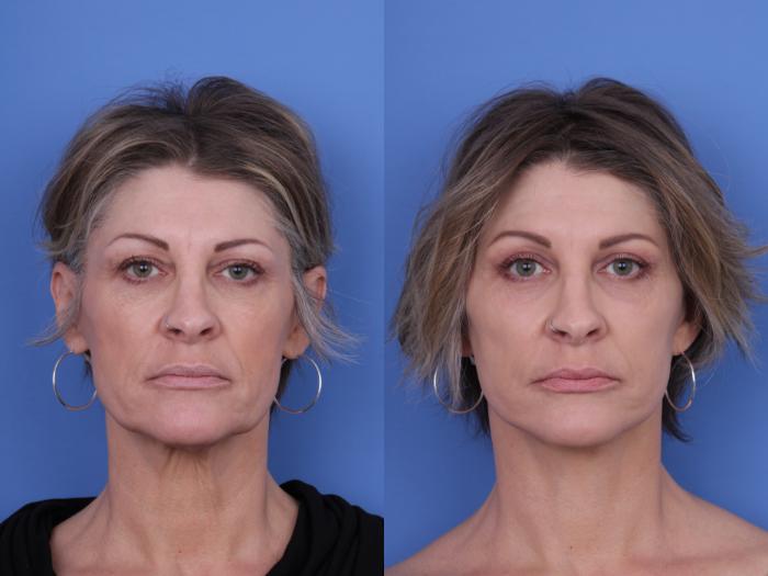 Before & After Facelift Case 718 Front View in Scottsdale, AZ