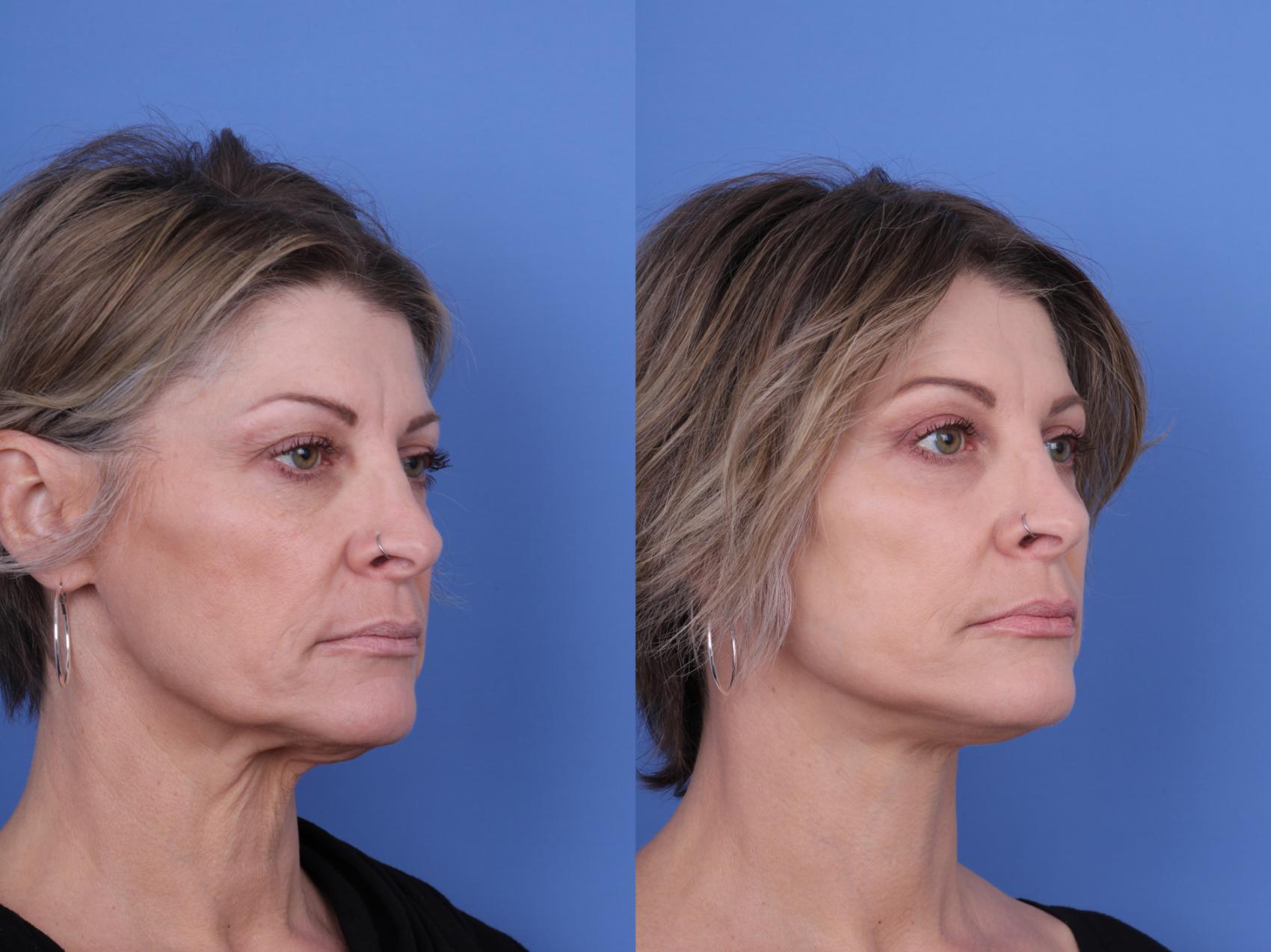 Before & After Facelift Case 718 Right Oblique View in Scottsdale, AZ