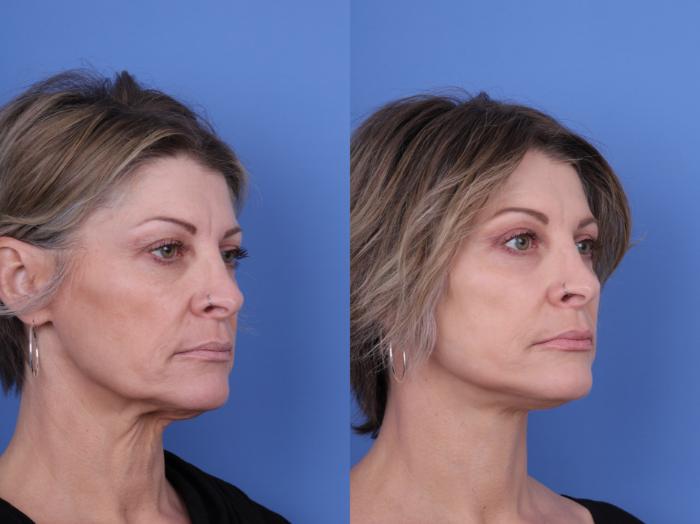 Before & After Facelift Case 718 Right Oblique View in Scottsdale, AZ