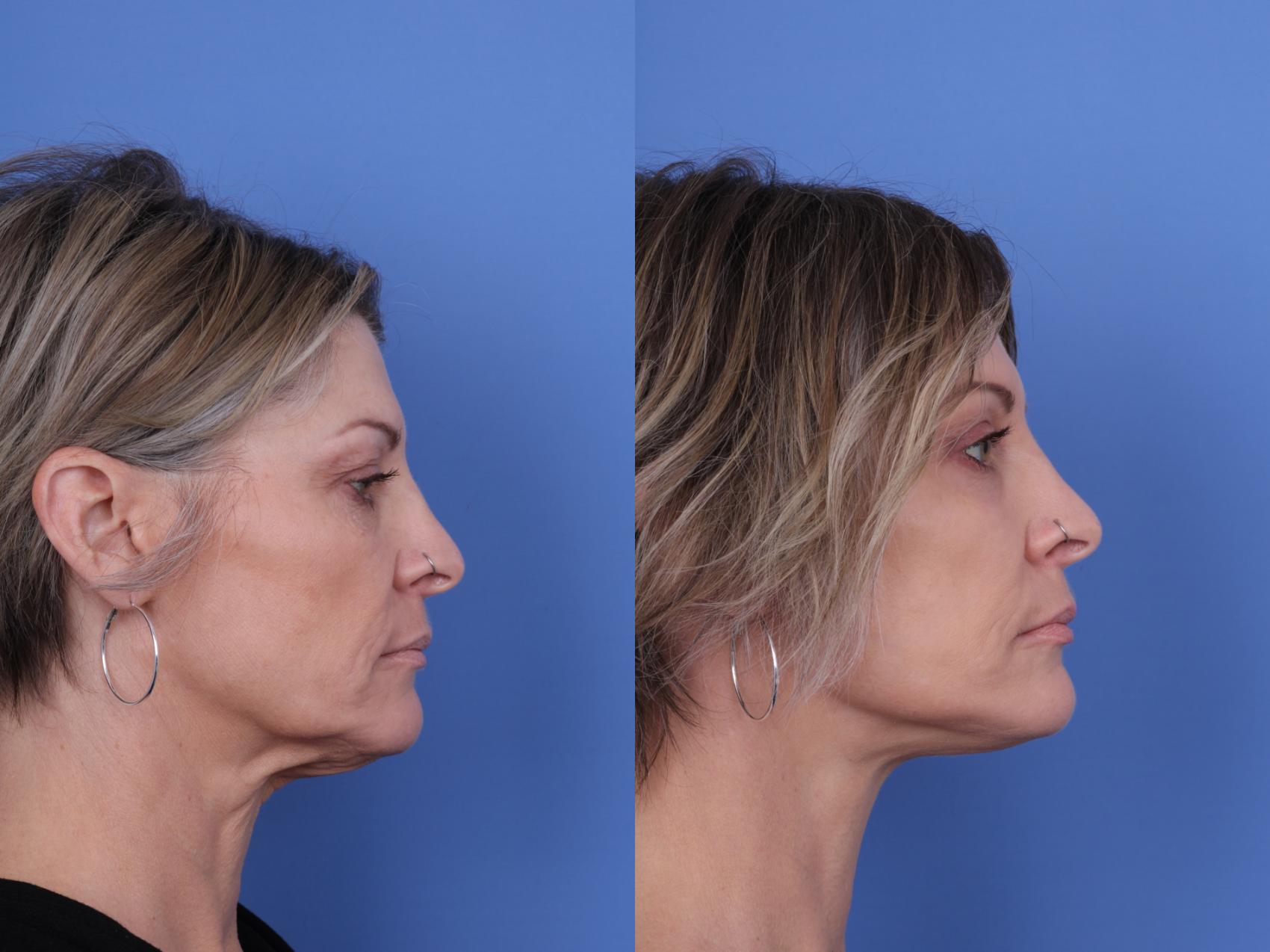Before & After Facelift Case 718 Right Side View in Scottsdale, AZ