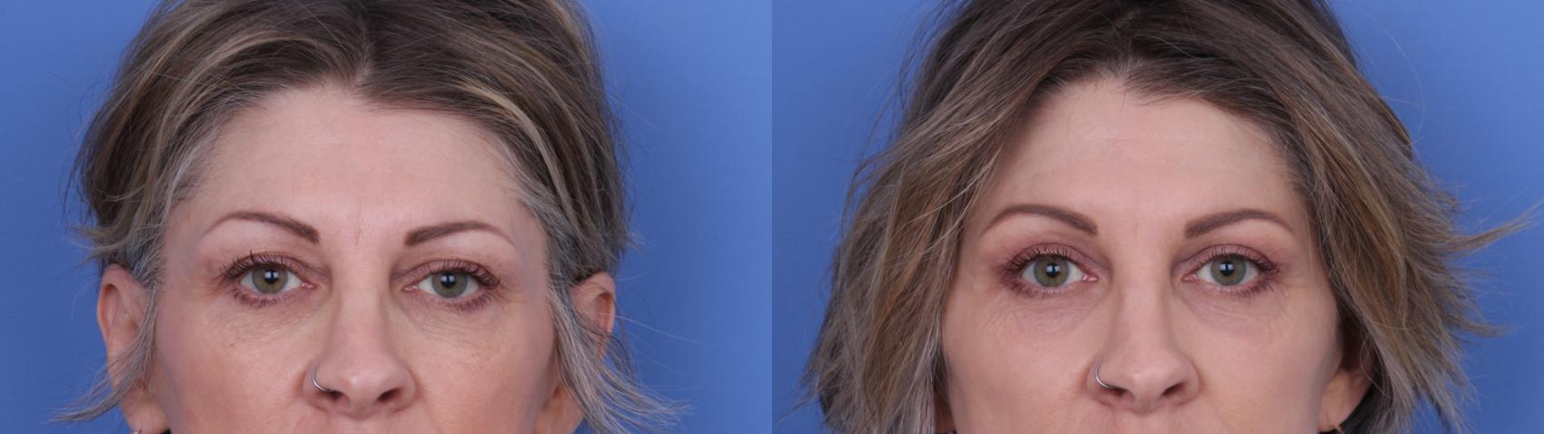 Before & After Facelift Case 718 Zoom Blepharoplasty View in Scottsdale, AZ