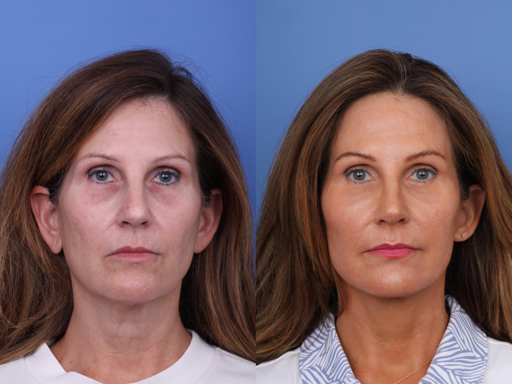 Before & After Facelift Case 720 Front View in Scottsdale, AZ
