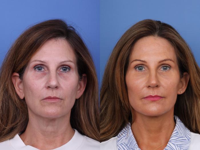 Before & After Facelift Case 720 Front View in Scottsdale, AZ
