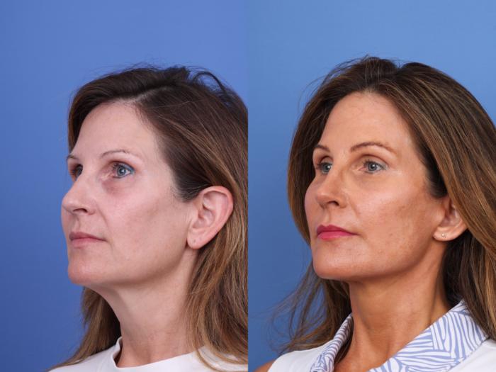Before & After Facelift Case 720 Left Oblique View in Scottsdale, AZ