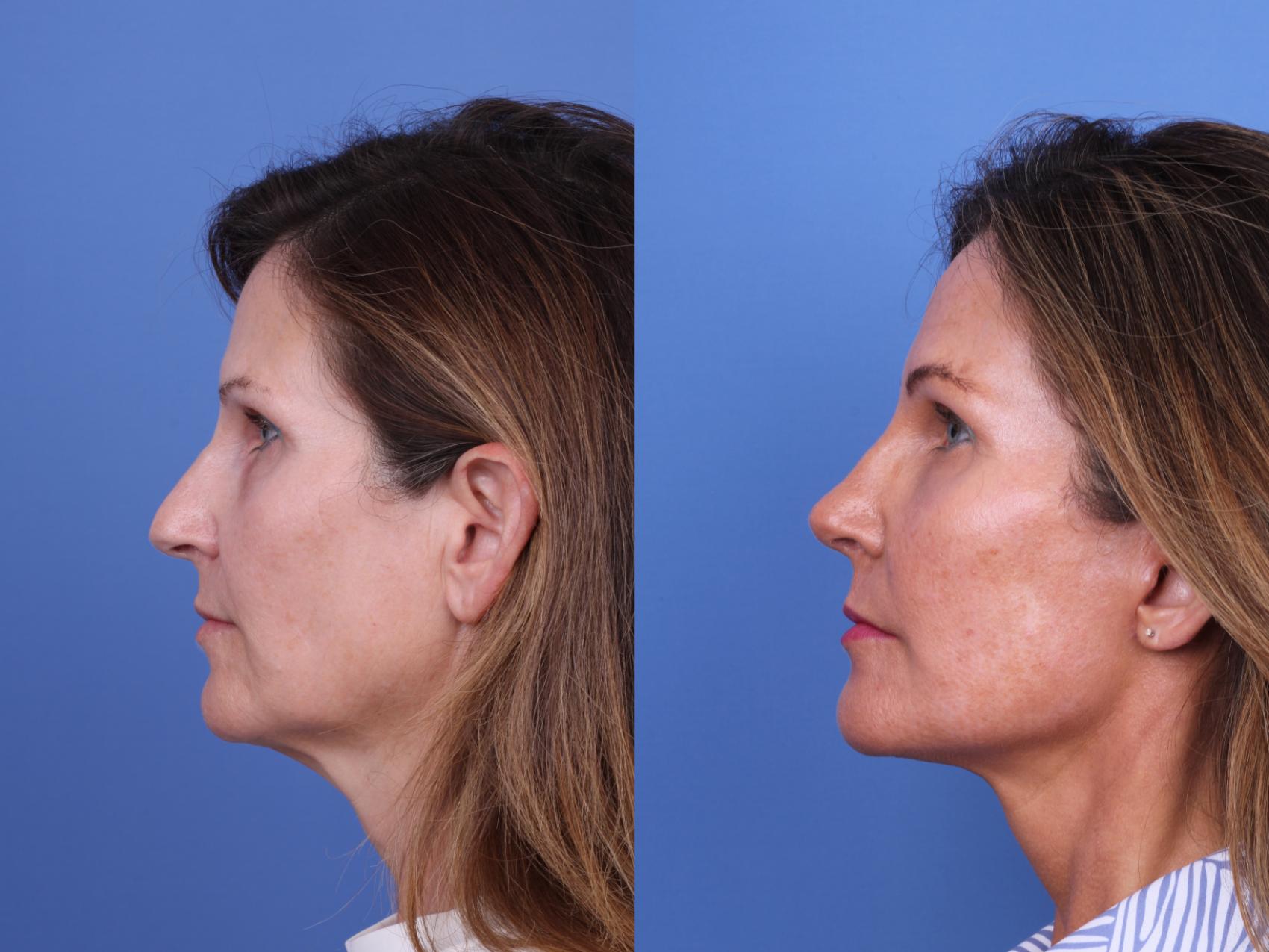 Before & After Facelift Case 720 Left Side View in Scottsdale, AZ