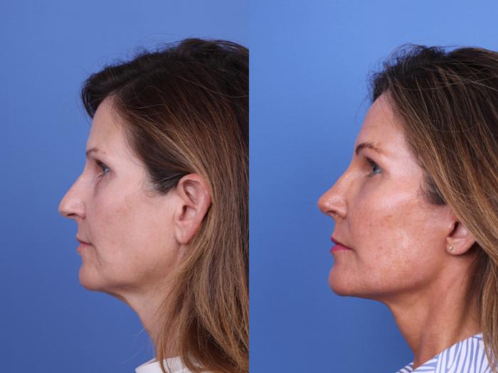Before & After Facelift Case 720 Left Side View in Scottsdale, AZ