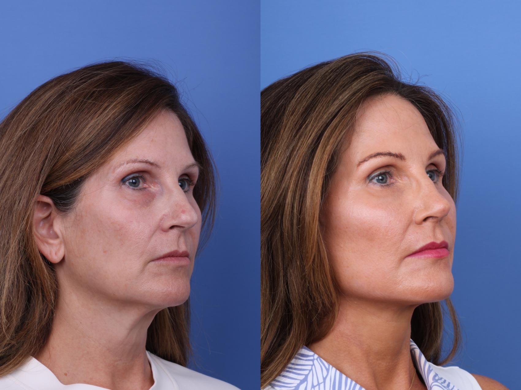 Before & After Facelift Case 720 Right Oblique View in Scottsdale, AZ