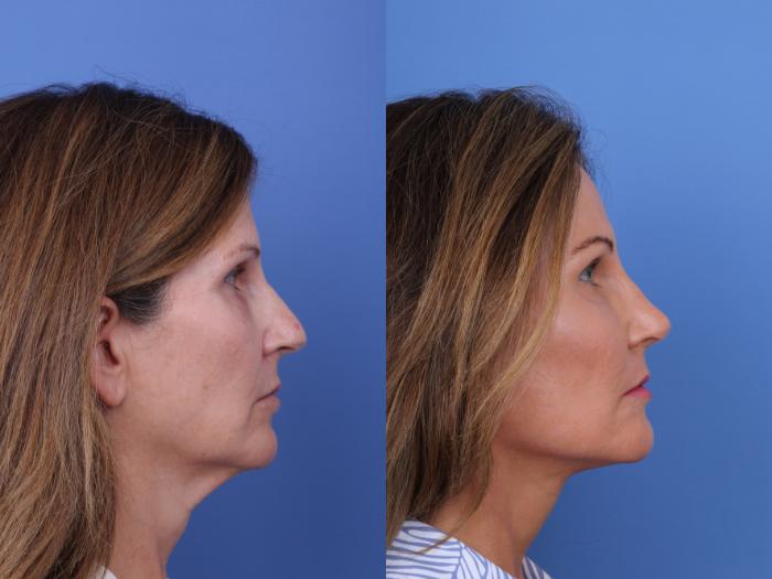 Before & After Facelift Case 720 Right Side View in Scottsdale, AZ