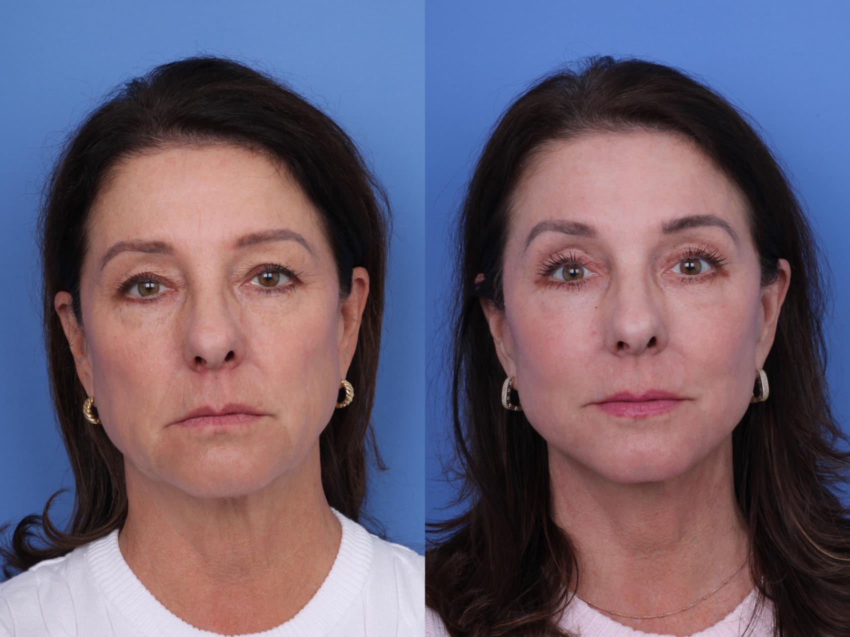 Before & After Facelift Case 722 Front View in Scottsdale, AZ