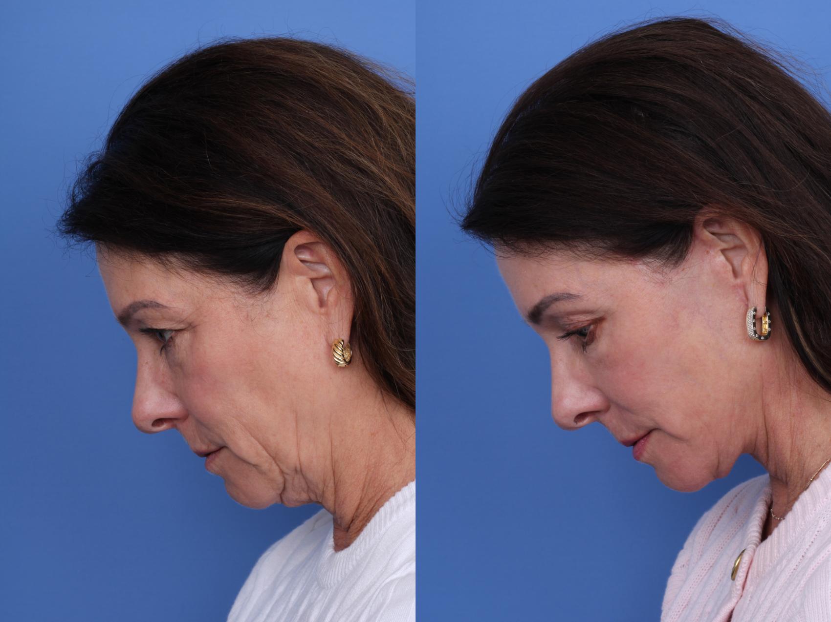 Before & After Facelift Case 722 Left Neck Flexion View in Scottsdale, AZ