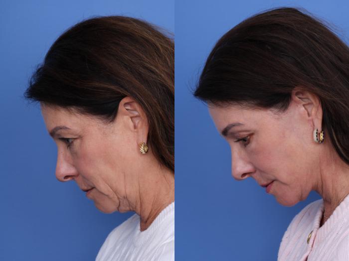 Before & After Facelift Case 722 Left Neck Flexion View in Scottsdale, AZ