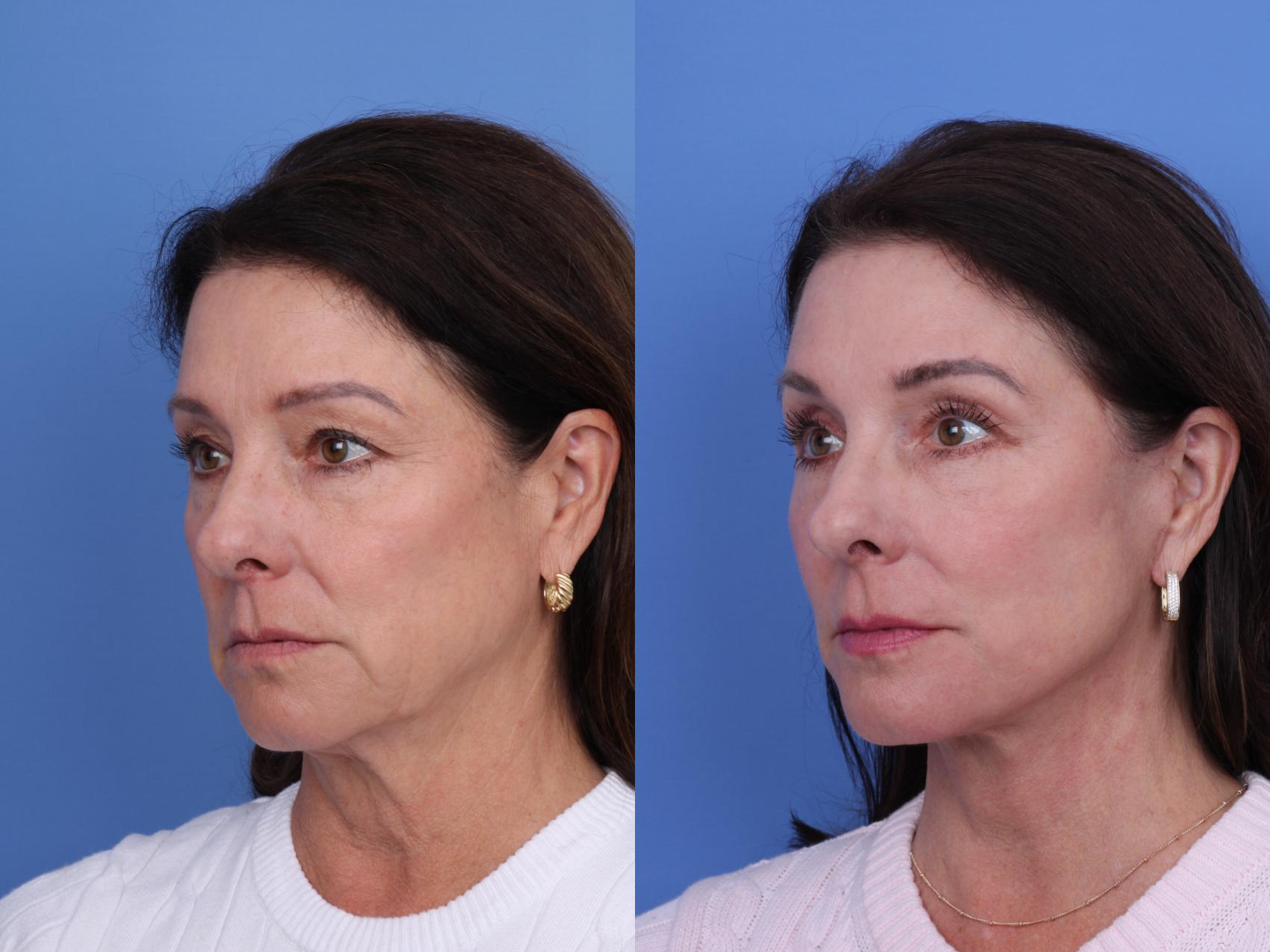 Before & After Facelift Case 722 Left Oblique View in Scottsdale, AZ
