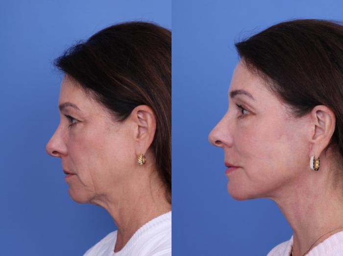 Before & After Facelift Case 722 Left Side View in Scottsdale, AZ