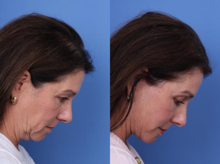 Before & After Facelift Case 722 Right Neck Flexion View in Scottsdale, AZ