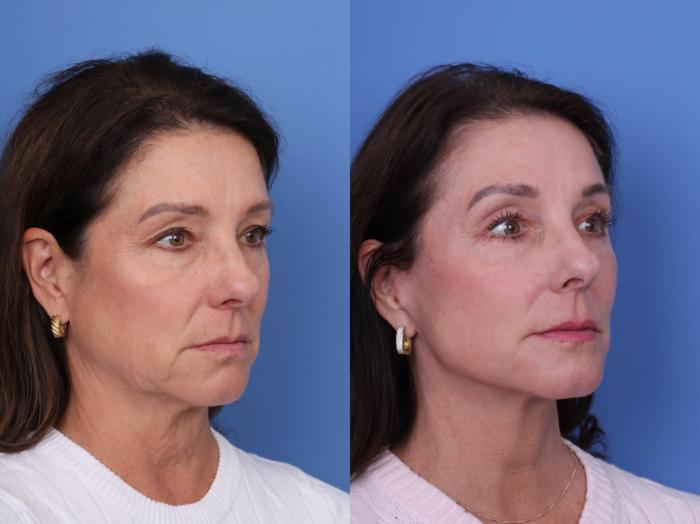 Before & After Facelift Case 722 Right Oblique View in Scottsdale, AZ
