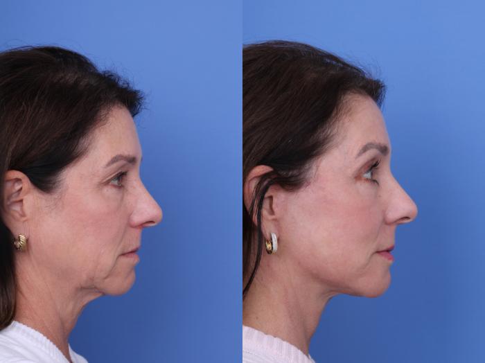 Before & After Facelift Case 722 Right Side View in Scottsdale, AZ