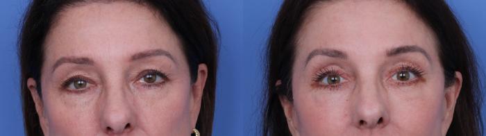 Before & After Facelift Case 722 Zoom Blepharoplasty View in Scottsdale, AZ