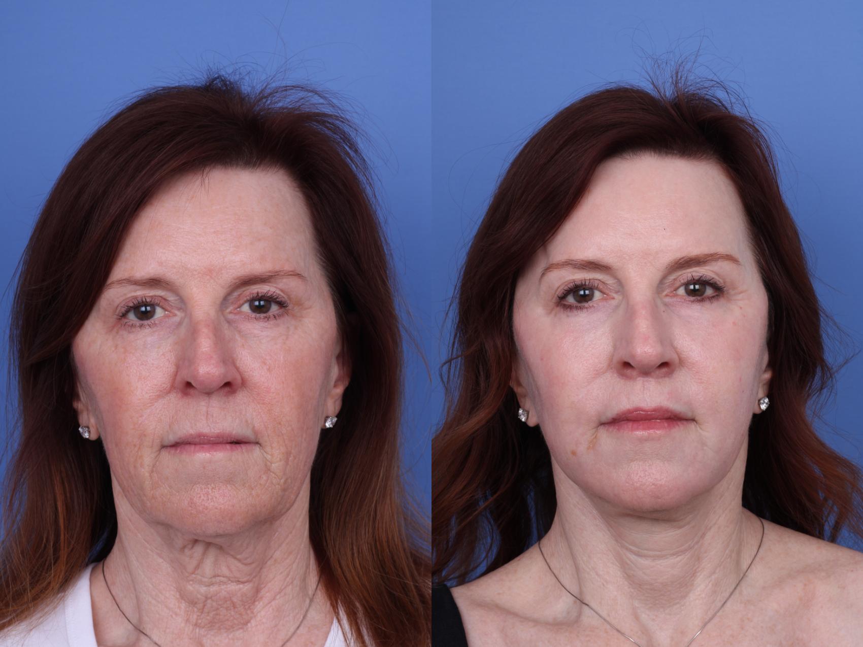 Before & After CO2 Laser Resurfacing (under anesthesia) Case 723 Front View in Scottsdale, AZ