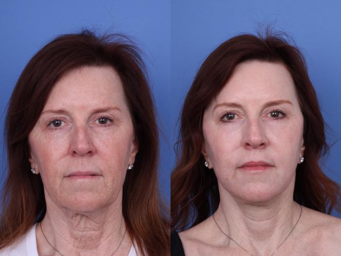 Before & After CO2 Laser Resurfacing (under anesthesia) Case 723 Front View in Scottsdale, AZ