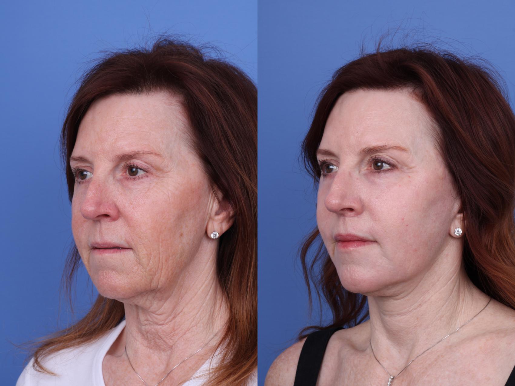 Before & After CO2 Laser Resurfacing (under anesthesia) Case 723 Left Oblique View in Scottsdale, AZ