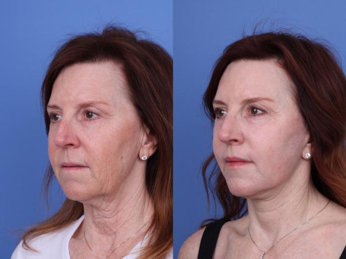 Before & After CO2 Laser Resurfacing (under anesthesia) Case 723 Left Oblique View in Scottsdale, AZ