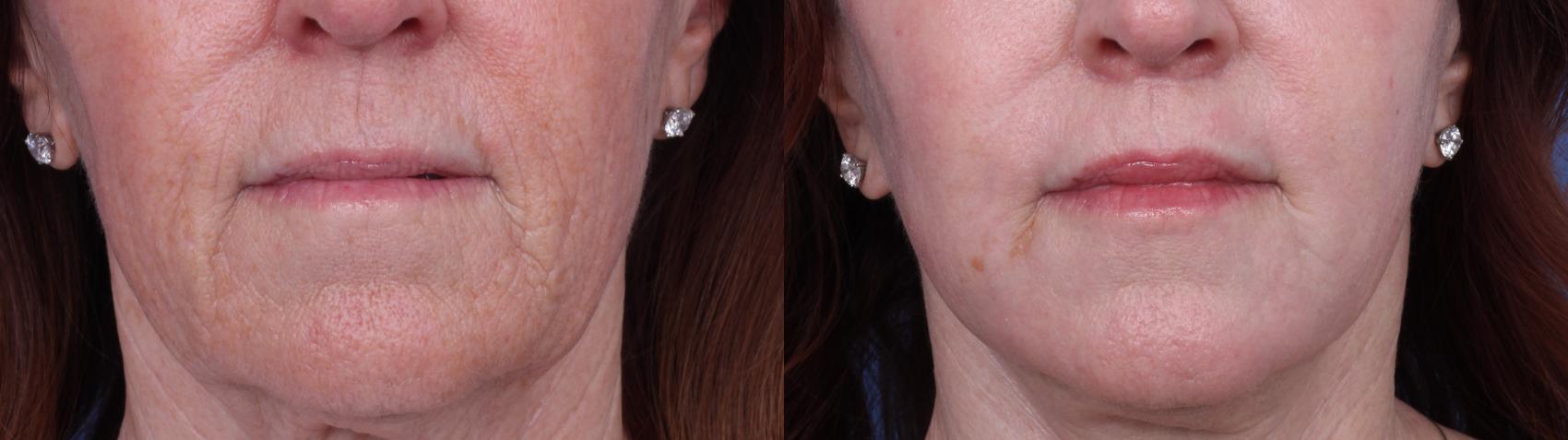 Before & After CO2 Laser Resurfacing (under anesthesia) Case 723 Zoom SNLL View in Scottsdale, AZ