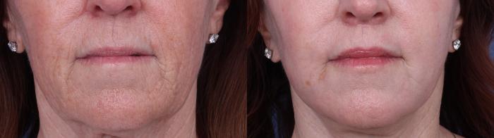 Before & After CO2 Laser Resurfacing (under anesthesia) Case 723 Zoom SNLL View in Scottsdale, AZ