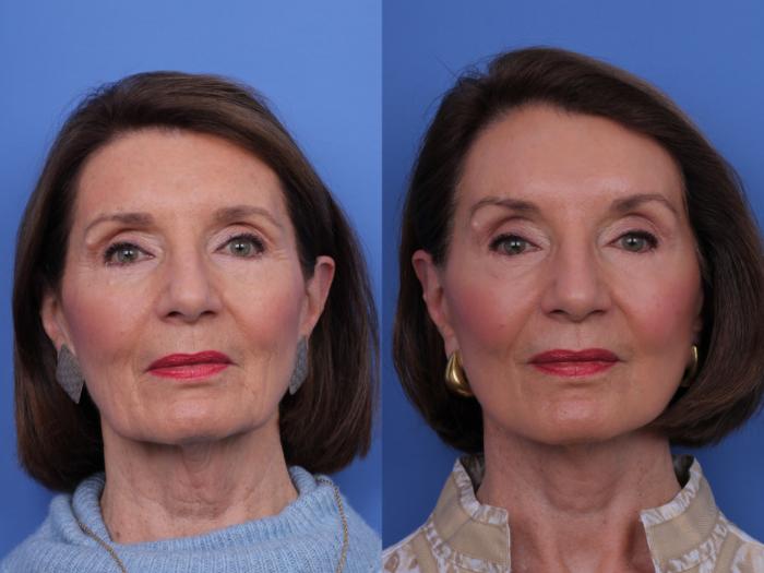 Before & After CO2 Laser Resurfacing (under anesthesia) Case 725 Front View in Scottsdale, AZ