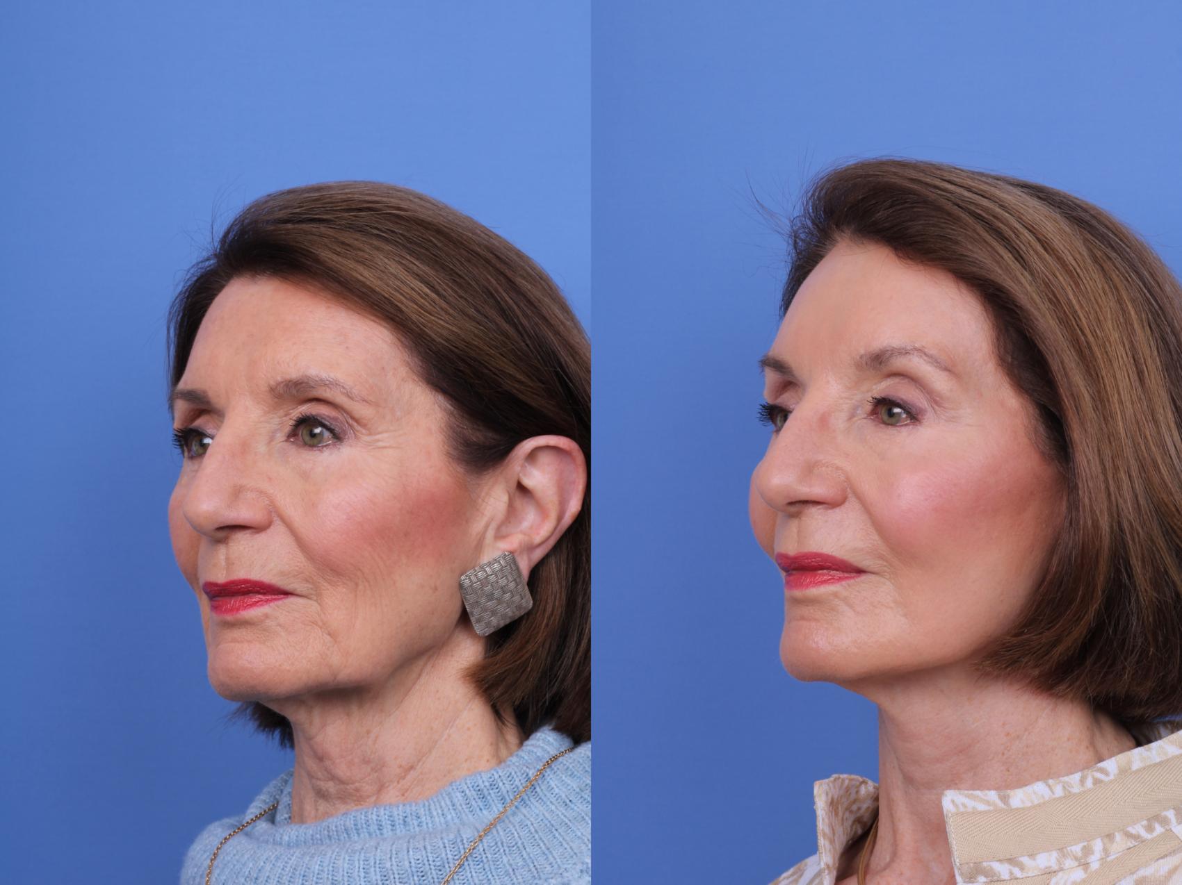 Before & After CO2 Laser Resurfacing (under anesthesia) Case 725 Left Oblique View in Scottsdale, AZ