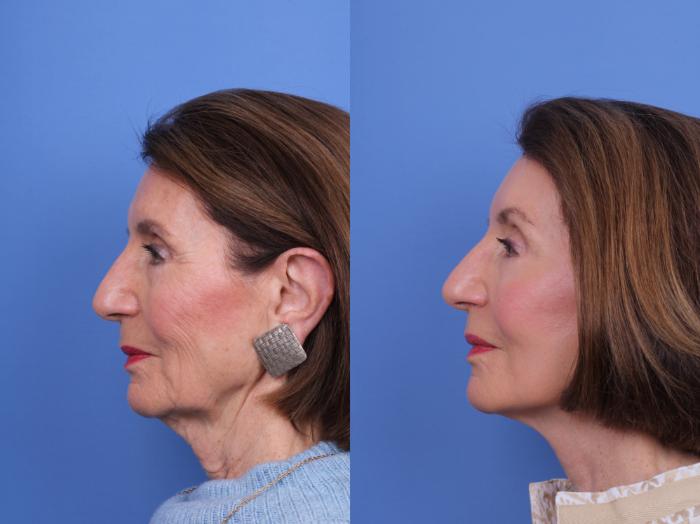 Before & After CO2 Laser Resurfacing (under anesthesia) Case 725 Left Side View in Scottsdale, AZ