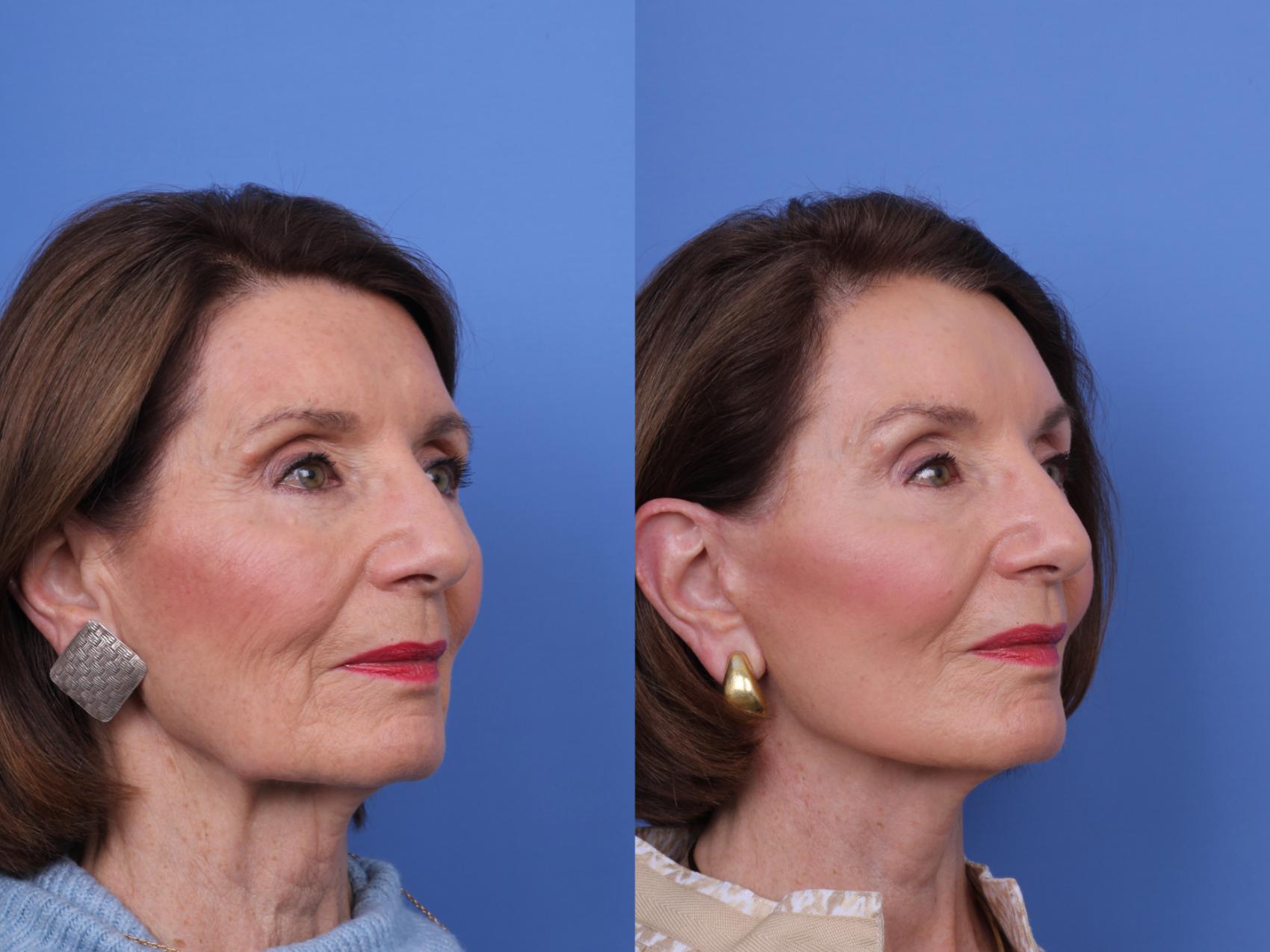 Before & After CO2 Laser Resurfacing (under anesthesia) Case 725 Right Oblique View in Scottsdale, AZ