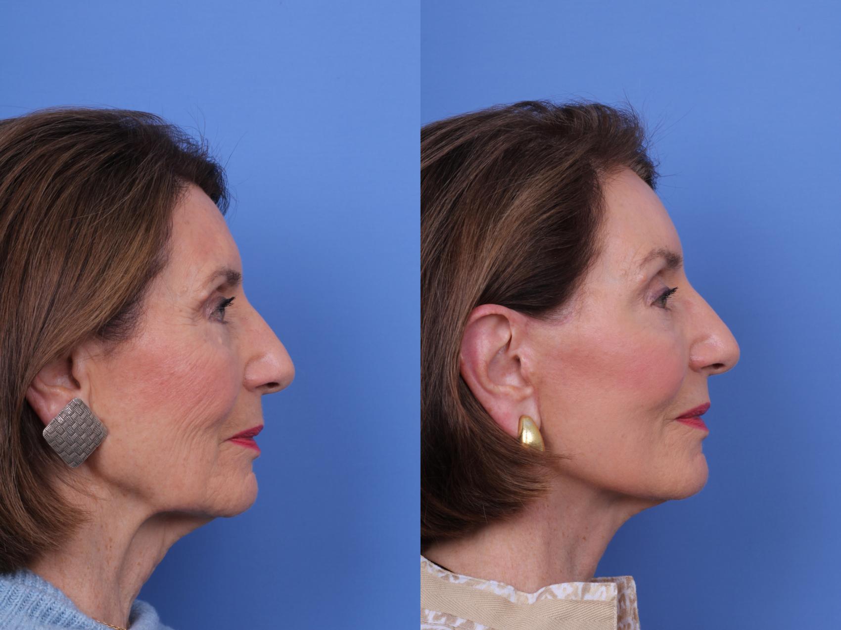 Before & After CO2 Laser Resurfacing (under anesthesia) Case 725 Right Side View in Scottsdale, AZ