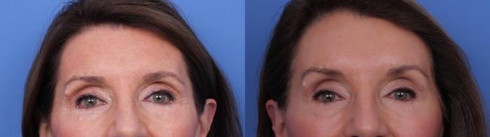 Before & After CO2 Laser Resurfacing (under anesthesia) Case 725 Zoom Endoscopic Forehead View in Scottsdale, AZ