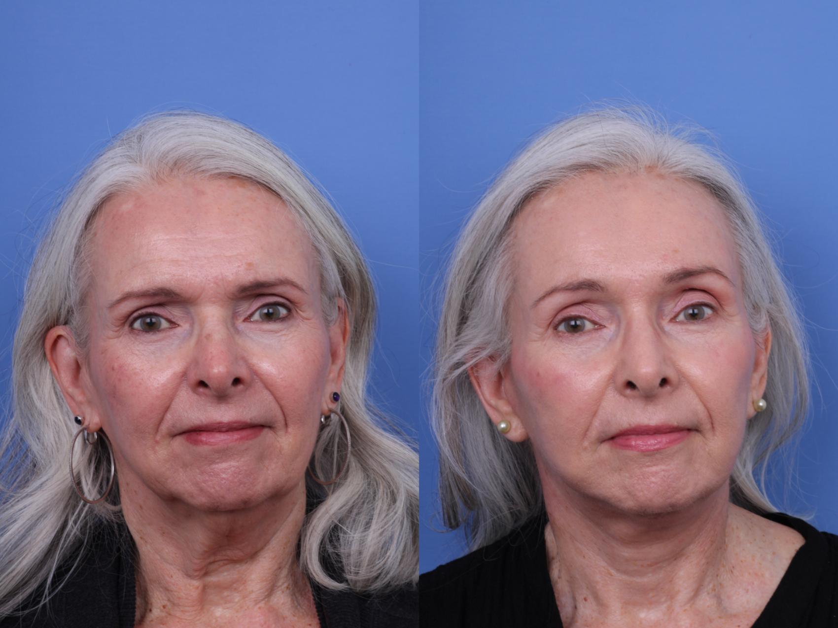 Before & After CO2 Laser Resurfacing (under anesthesia) Case 727 Front View in Scottsdale, AZ