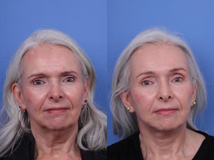 Before & After CO2 Laser Resurfacing (under anesthesia) Case 727 Front View in Scottsdale, AZ