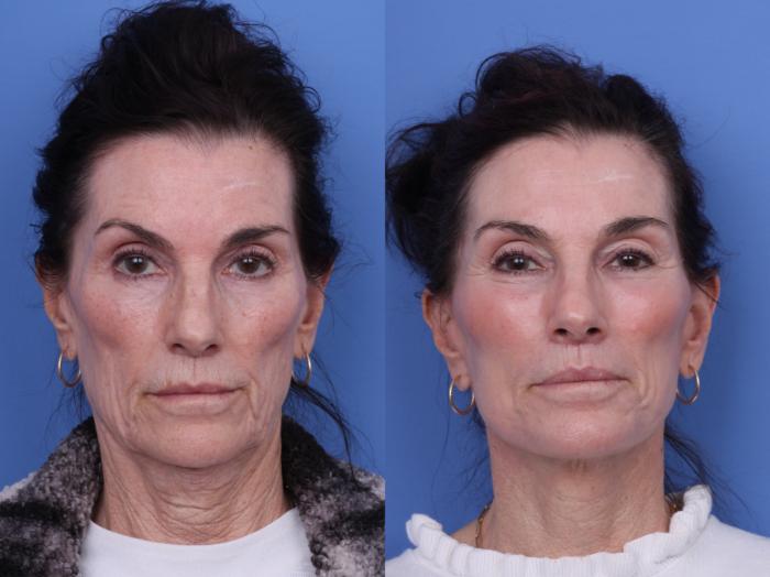 Before & After CO2 Laser Resurfacing (under anesthesia) Case 729 Front View in Scottsdale, AZ