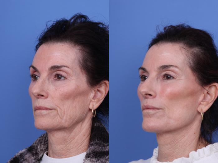 Before & After CO2 Laser Resurfacing (under anesthesia) Case 729 Left Oblique View in Scottsdale, AZ