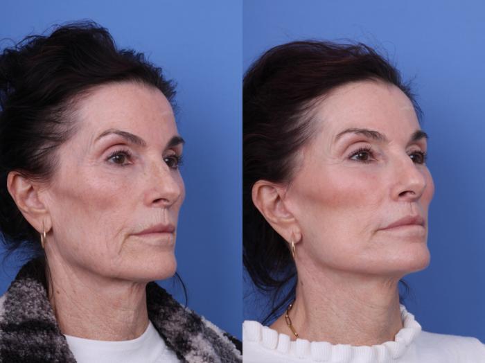 Before & After CO2 Laser Resurfacing (under anesthesia) Case 729 Right Oblique View in Scottsdale, AZ