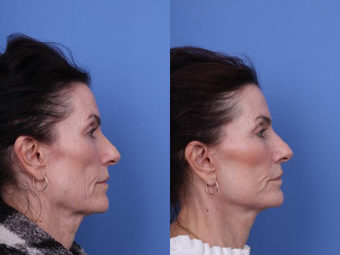 Before & After CO2 Laser Resurfacing (under anesthesia) Case 729 Right Side View in Scottsdale, AZ